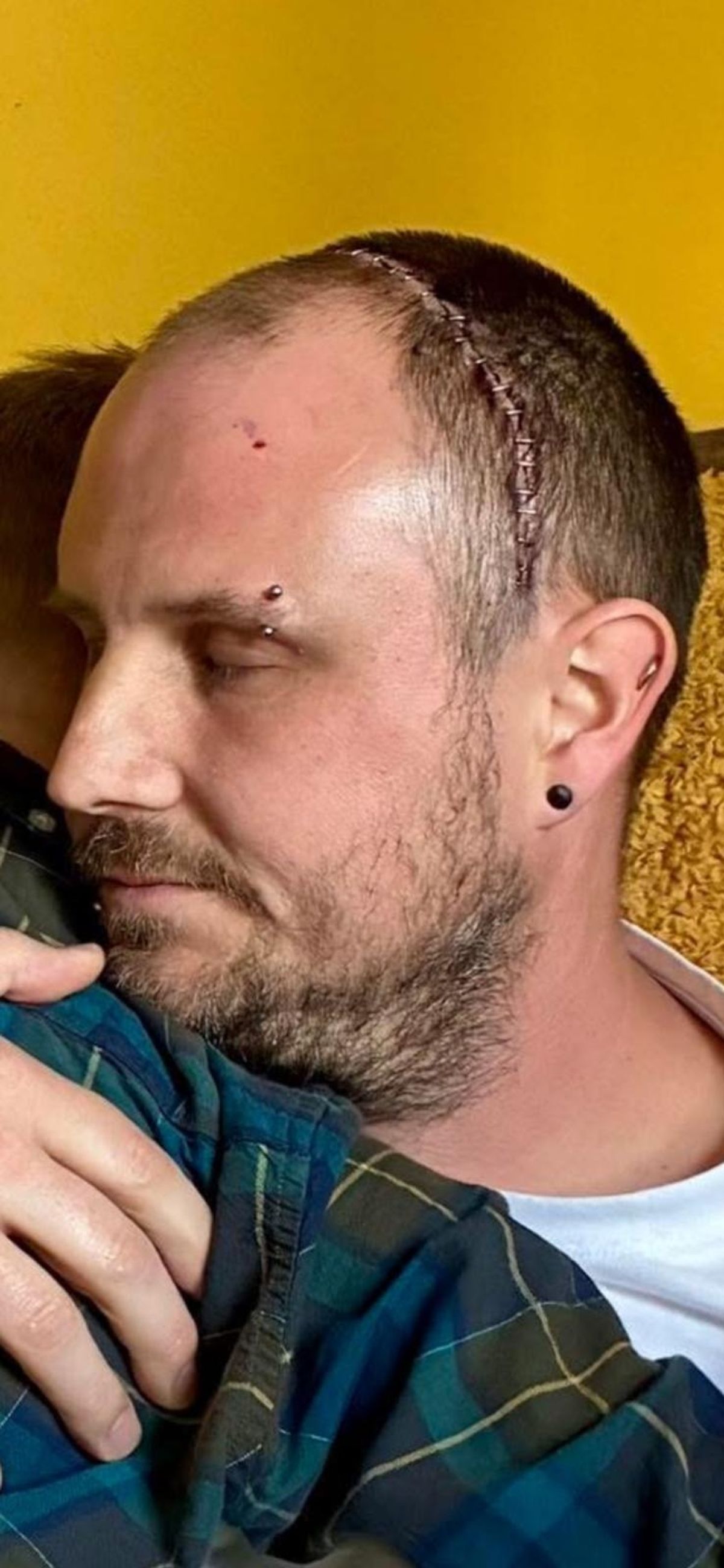 The scar Paul has been left with