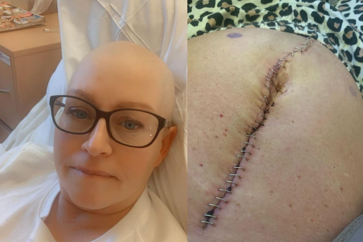Denise Hall during ovarian cancer treatment and her scar following surgery