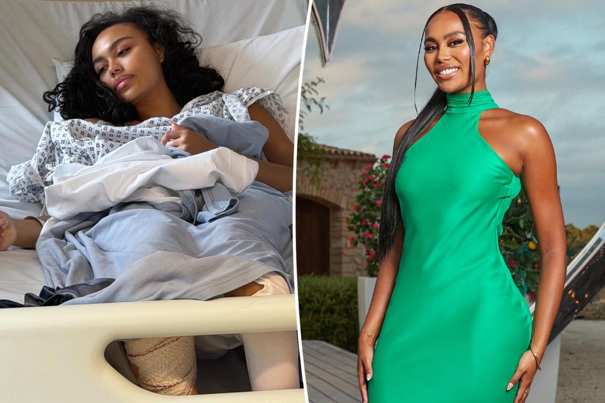 'Love Island UK' star Ella Thomas hospitalized for emergency surgery after freak accident