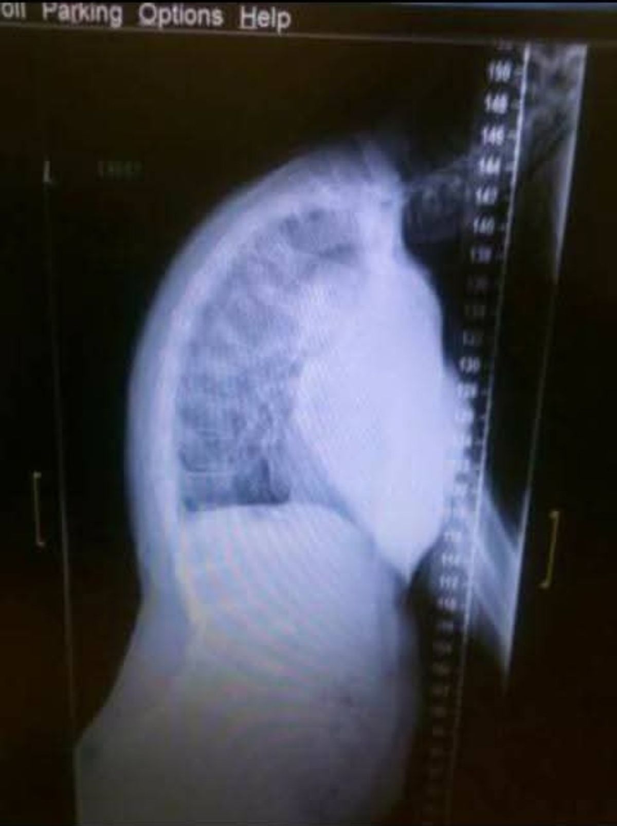 An x-ray of Simon's spine