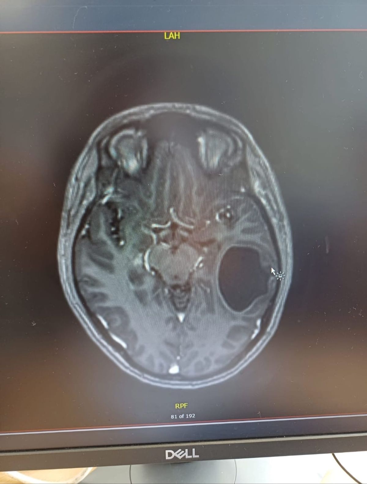 The MRI scan showing the huge tumour in her brain.