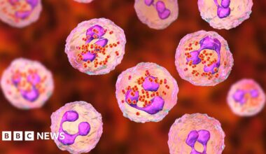 Meningococcal meningitis. Computer illustration showing cerebrospinal fluid containing numerous neutrophils with Neisseria meningitidis bacteria inside.