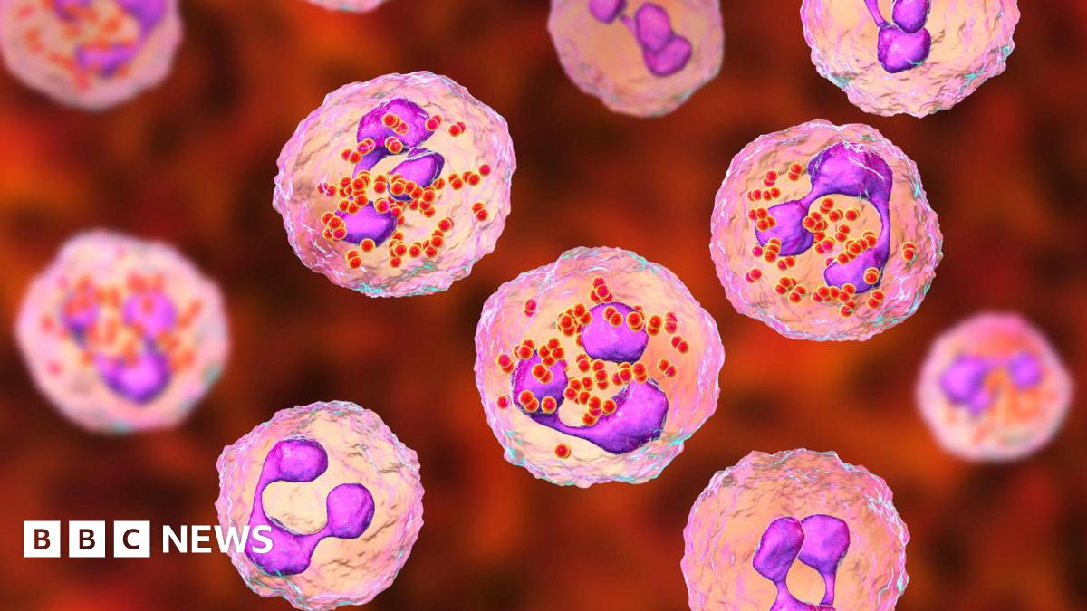 Meningococcal meningitis. Computer illustration showing cerebrospinal fluid containing numerous neutrophils with Neisseria meningitidis bacteria inside.