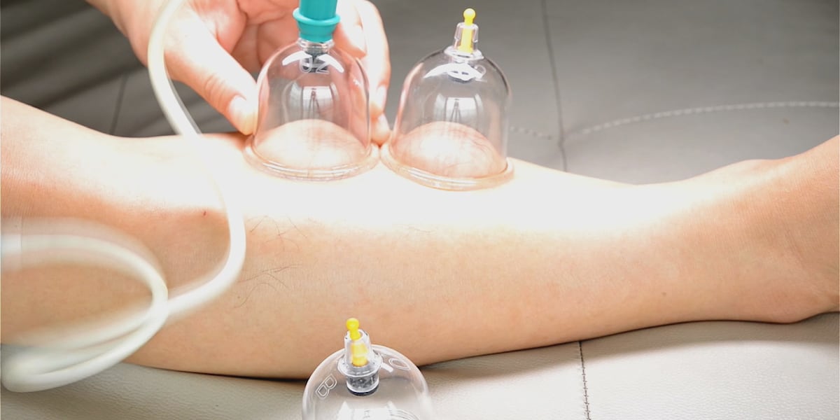 What exactly is cupping therapy?