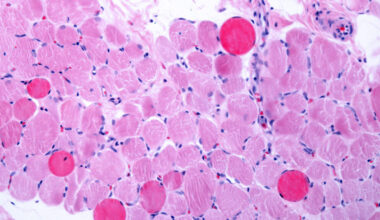 Capricor Therapeutics accuses Nippon Shinyaku of slow-walking Duchenne drug