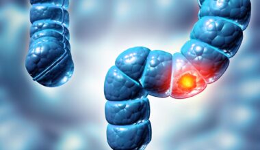 Colon Colorectal Cancer