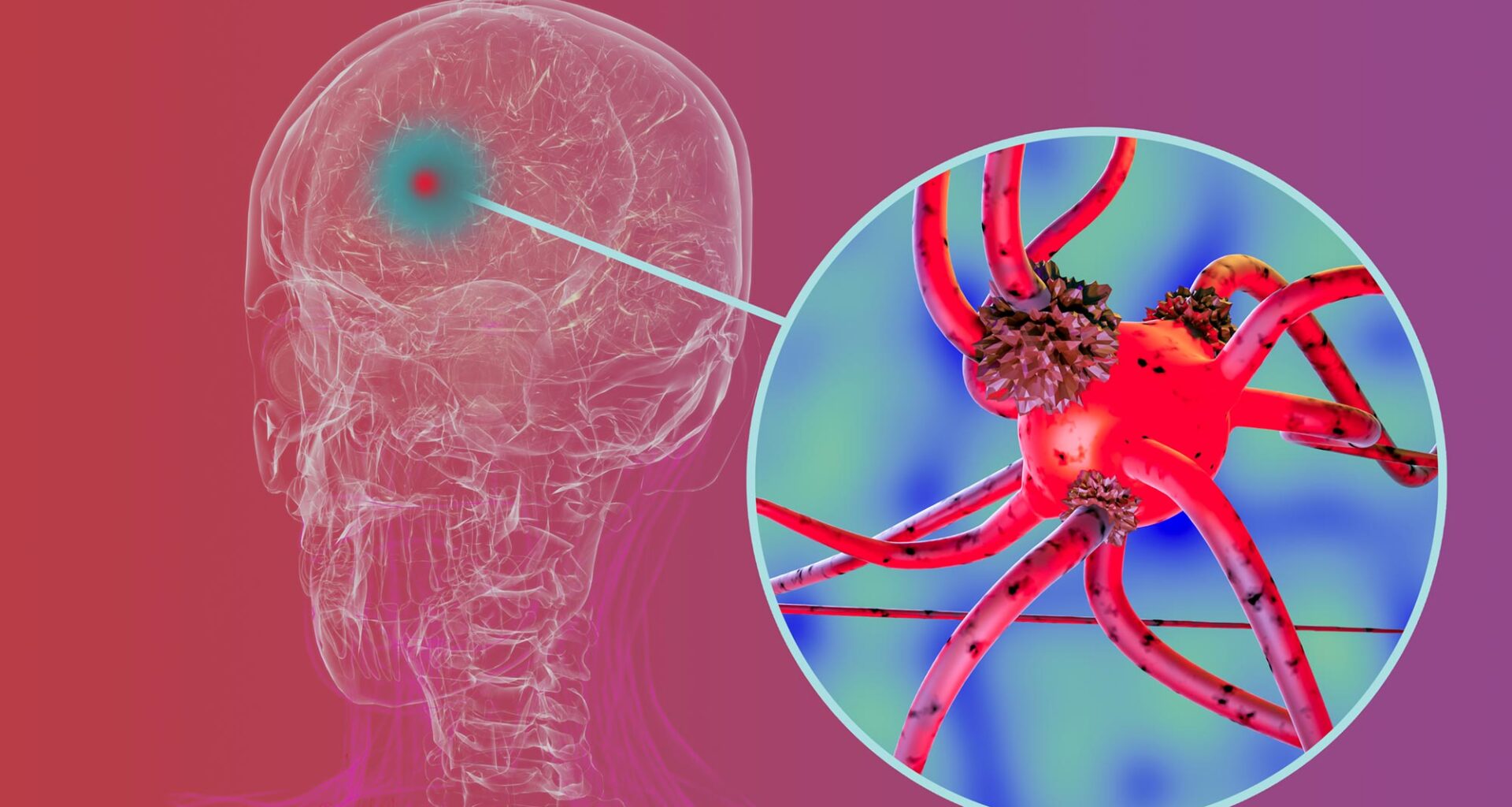 Human Brain Parkinsons Disease Neuron