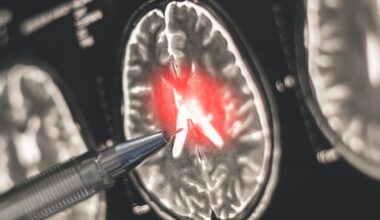 Women Face Much Higher MS Risk. A New Discovery May Help Explain Why. : ScienceAlert