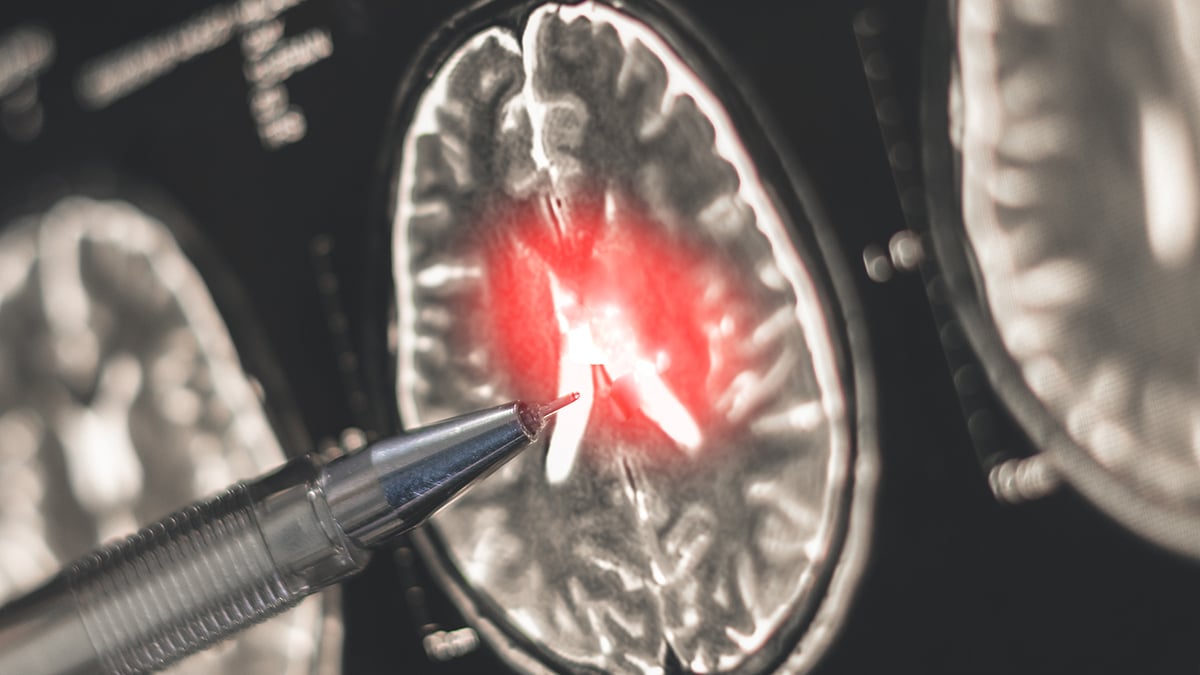 Women Face Much Higher MS Risk. A New Discovery May Help Explain Why. : ScienceAlert