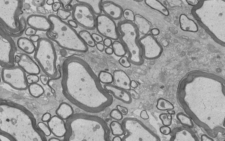 MS Neurons With Remyelinated Sheaths