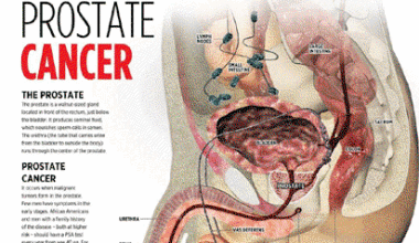 No diet, sex can prevent prostate cancer — Expert
