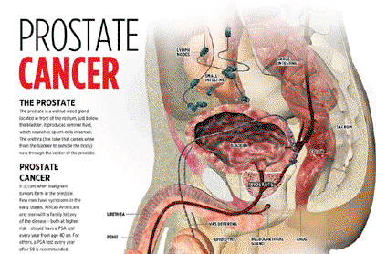 No diet, sex can prevent prostate cancer — Expert
