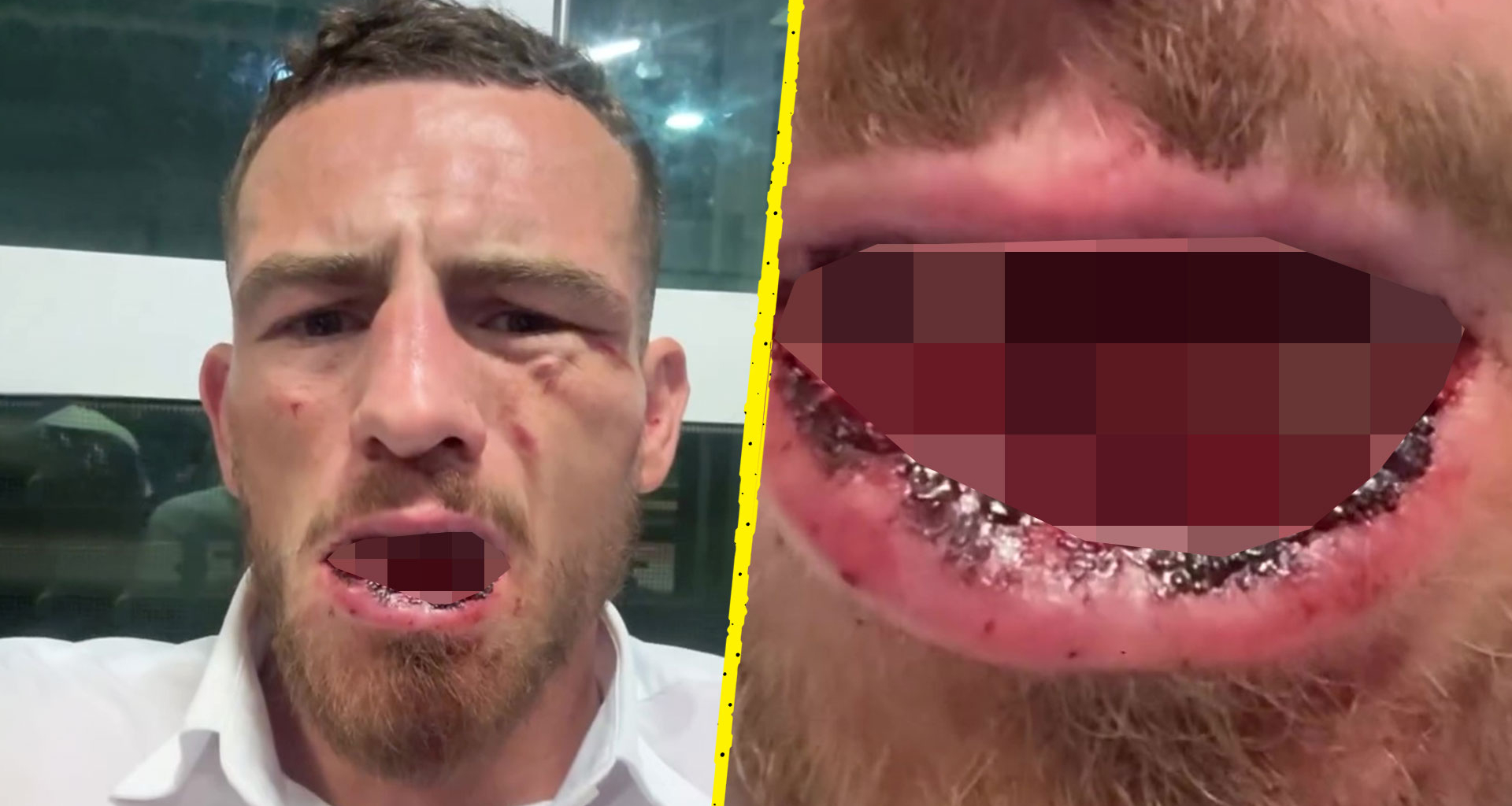 Bare-knuckle boxer retires after suffering gruesome injury in KO loss on Conor McGregor's BKFC