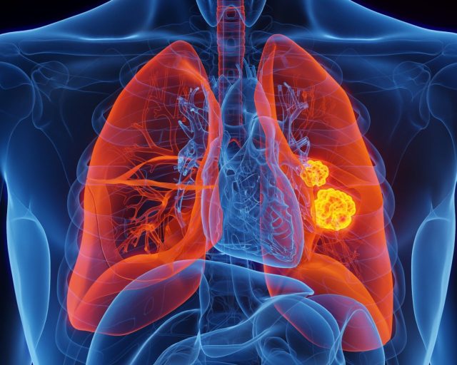 Lung cancer, illustration