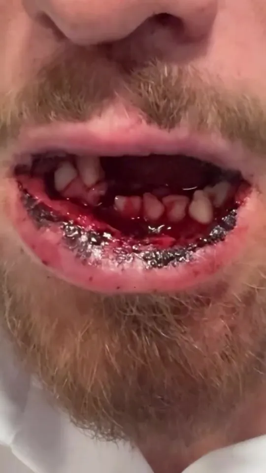 His jaw is broken in two places, and he will now step away from the sport