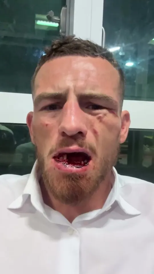 Tierney's jaw was left in a sorry state
