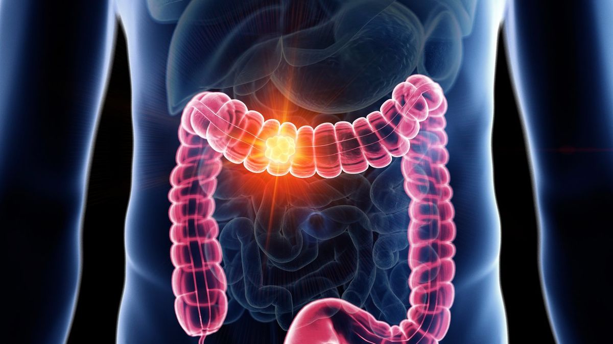 Oncologist who cut open people for 17 years saw same foods in 80% of colon cancer patients