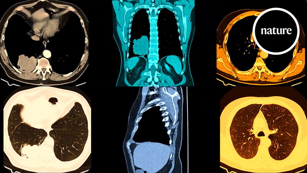 Could a pill prevent the world’s deadliest cancer?