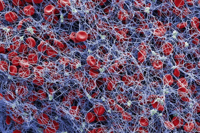 A coloured scanning electron micrograph of red blood cells and platelets in a fibrin mesh, resembling dots caught up in tangled thread.