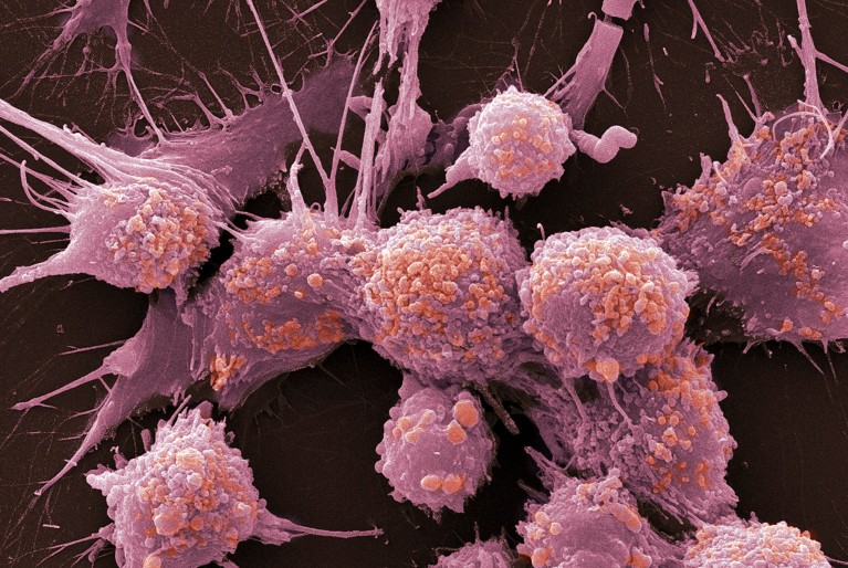 A coloured scanning electron micrograph of multiple pink rounded prostate cancer cells