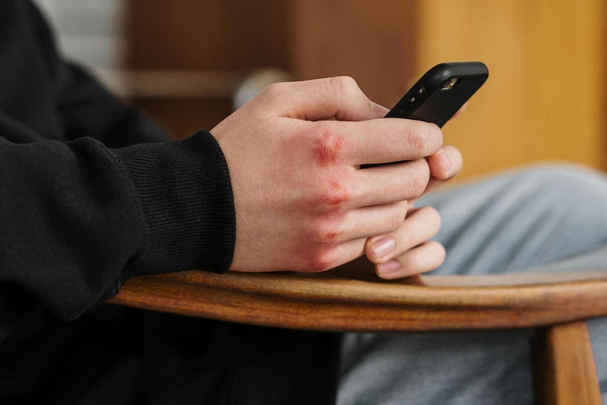 A boy with bruised knuckles sits and looks at his mobile phone.