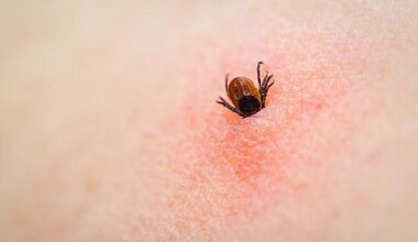 The problem with "classic" Lyme disease symptoms