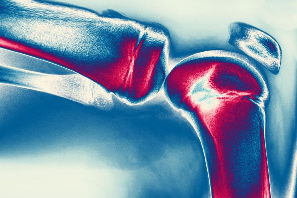 Inflammation