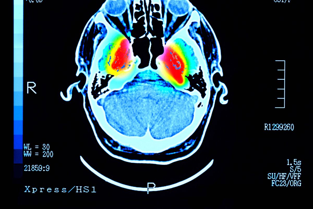 MRI Brain Scan