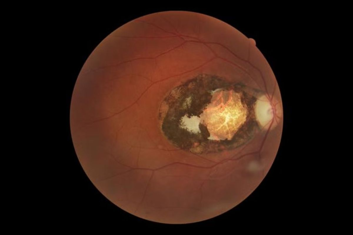 Eye lesion due to toxoplasmosis infection