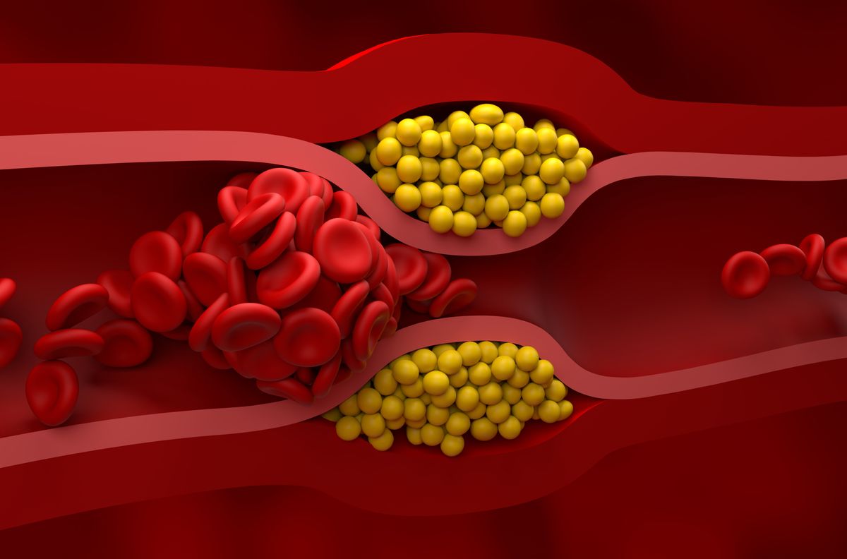 Illustration showing the interior of an artery blocked by atherosclerosis