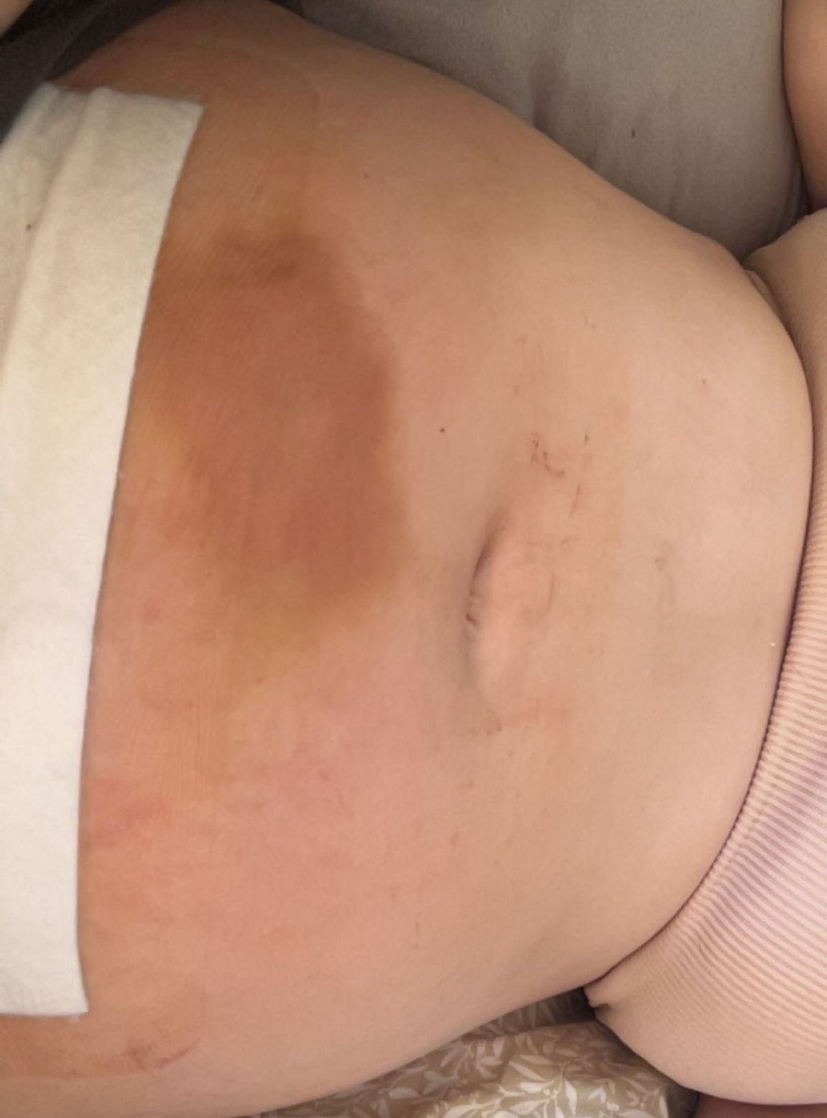 Shannon Brennan developed a large bruise above her C-section scar