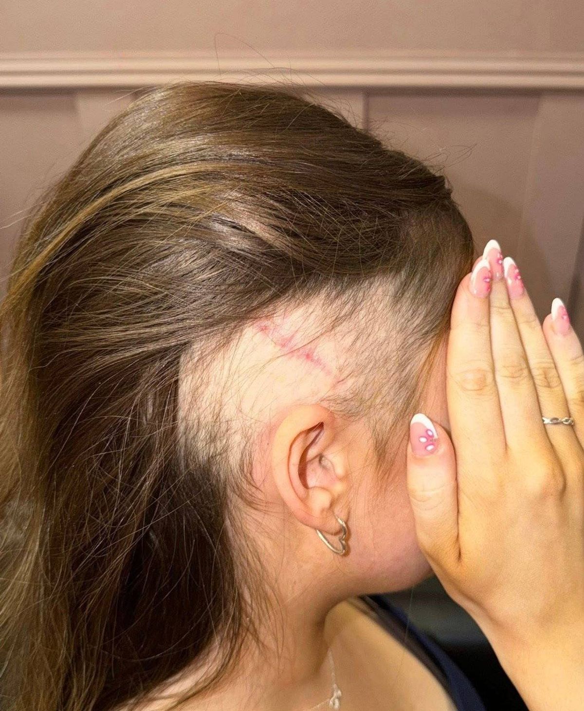 Annalise Donelon, after brain surgery