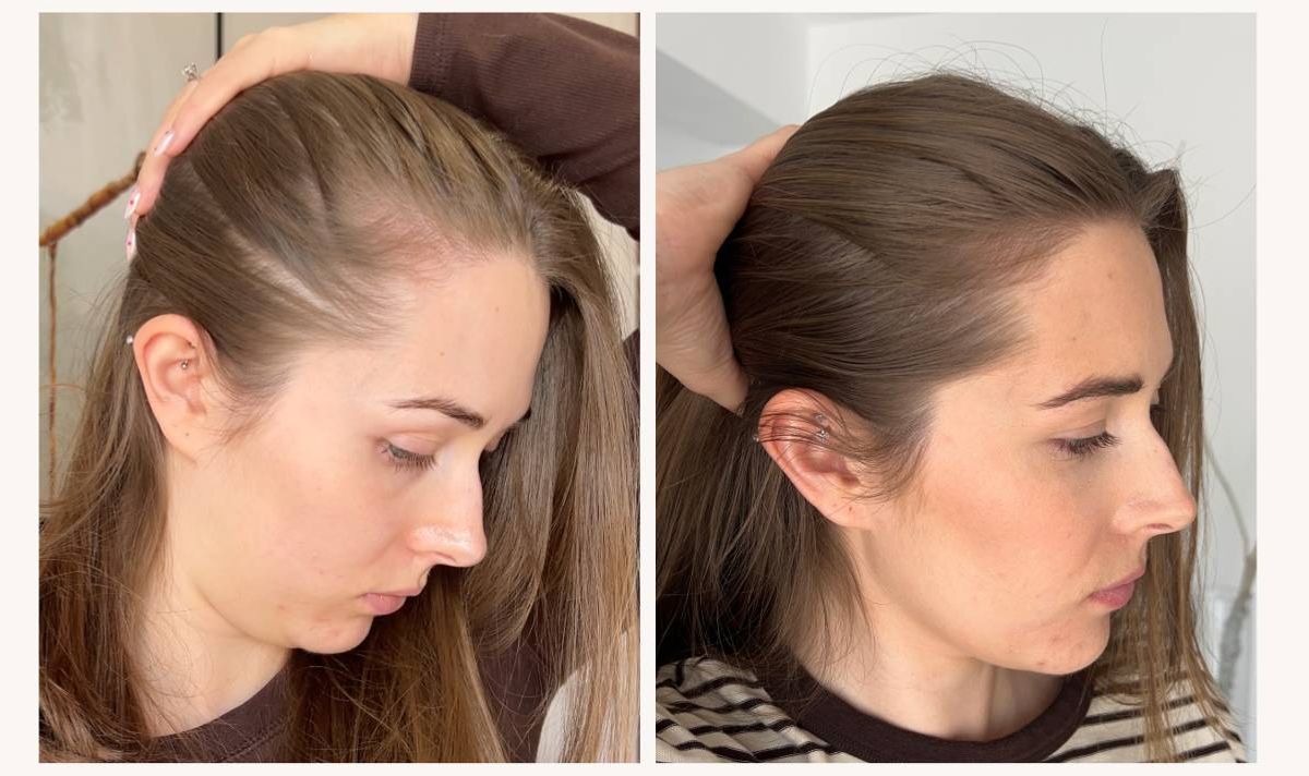 Before and after results using UKLASH's hair growth products