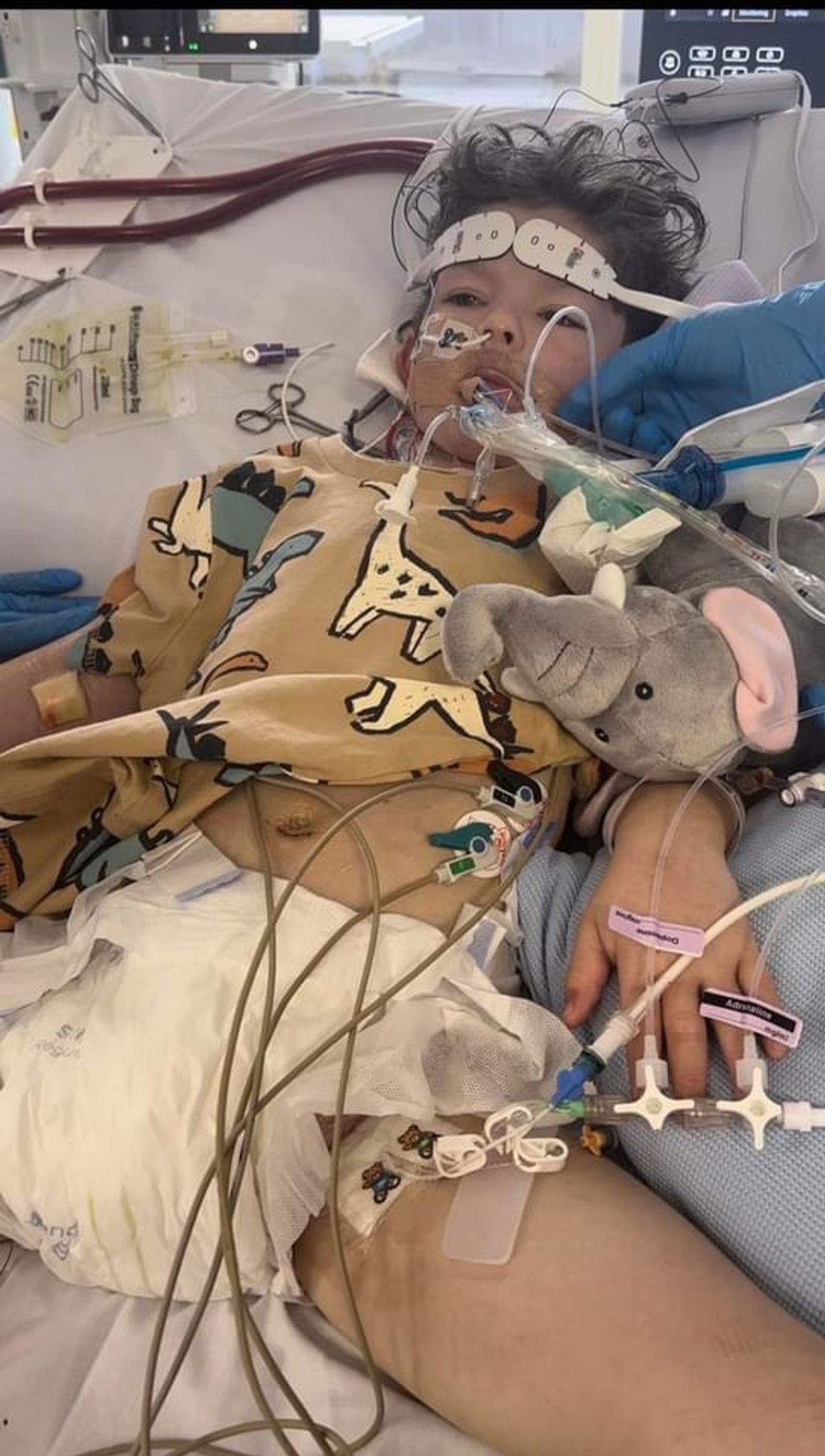 Rafi was placed in a coma, given an artificial lung and put on dialysis