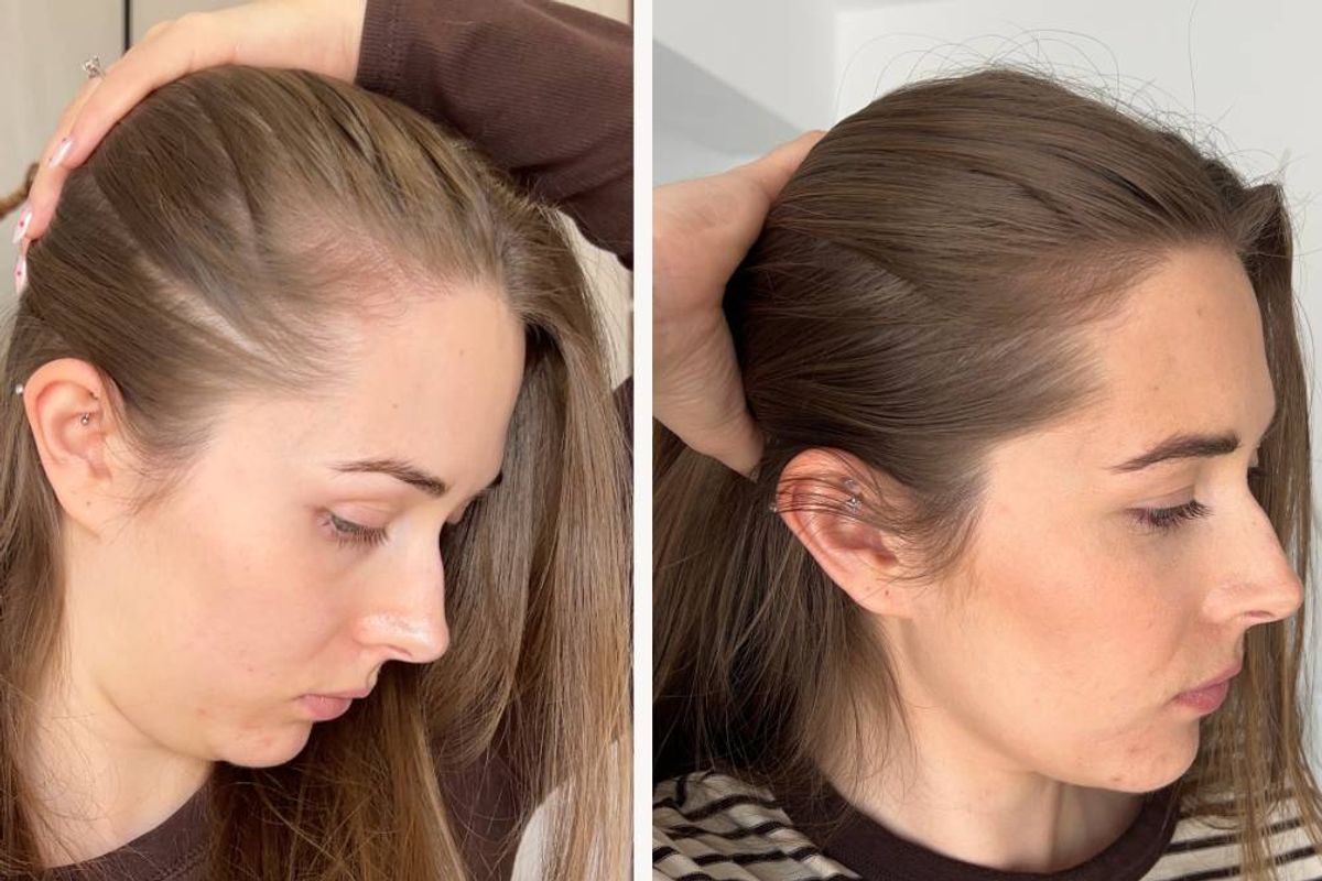 Before and after results using UKLASH's hair growth products