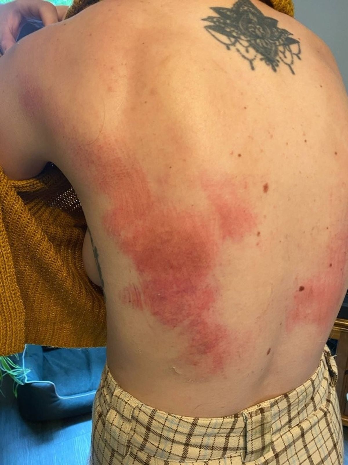 Sally's injured back