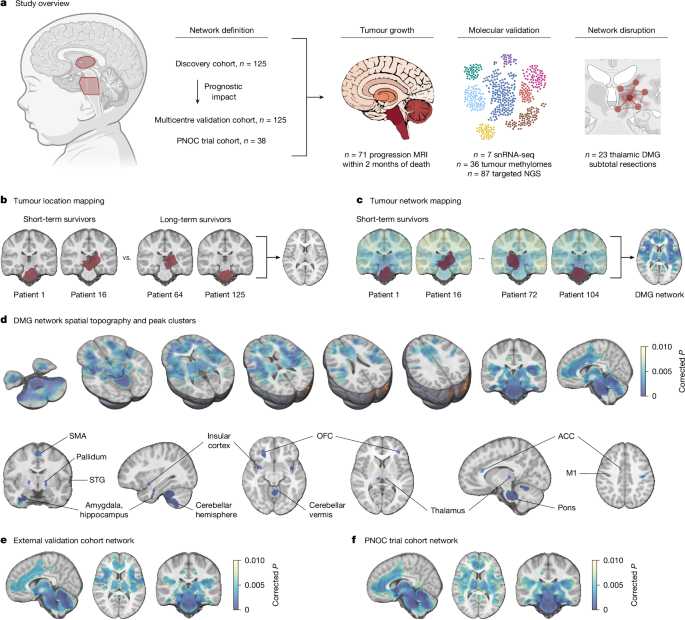 A prognostic human brain network for diffuse midline glioma