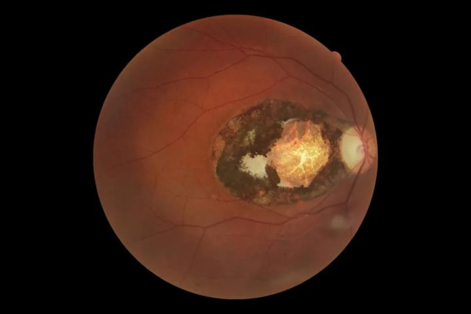 Eye lesion due to toxoplasmosis infection (João Furtado)
