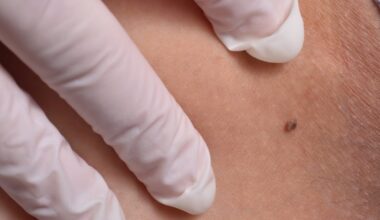 How To Tell If A Mole Is Skin Cancer Using The ABCDE Method