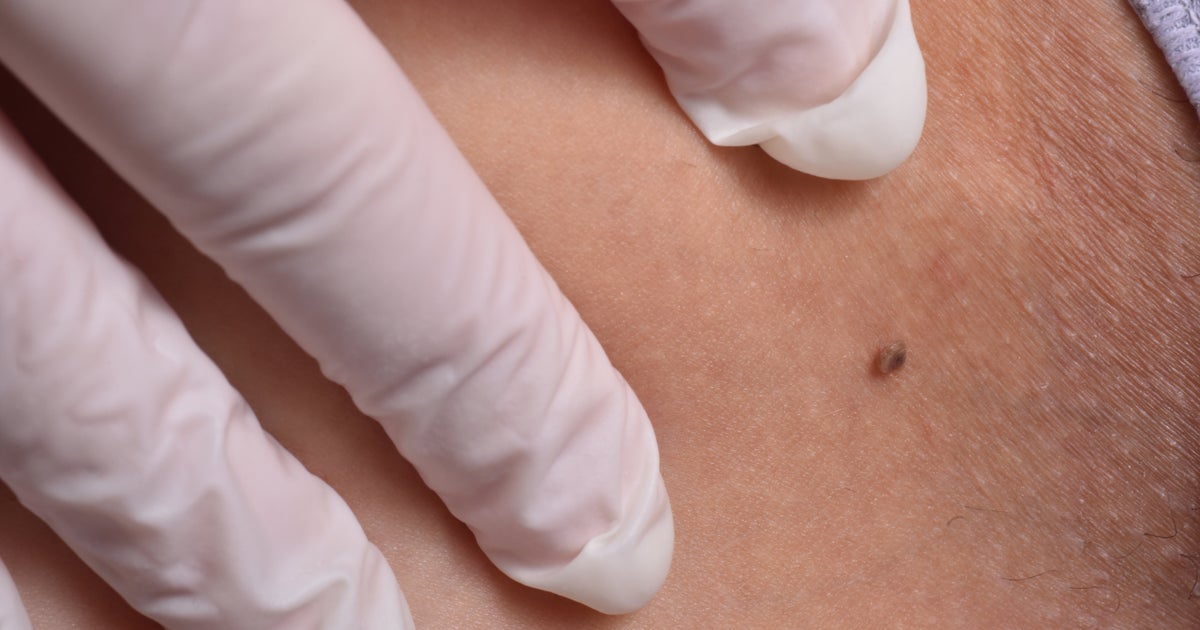 How To Tell If A Mole Is Skin Cancer Using The ABCDE Method