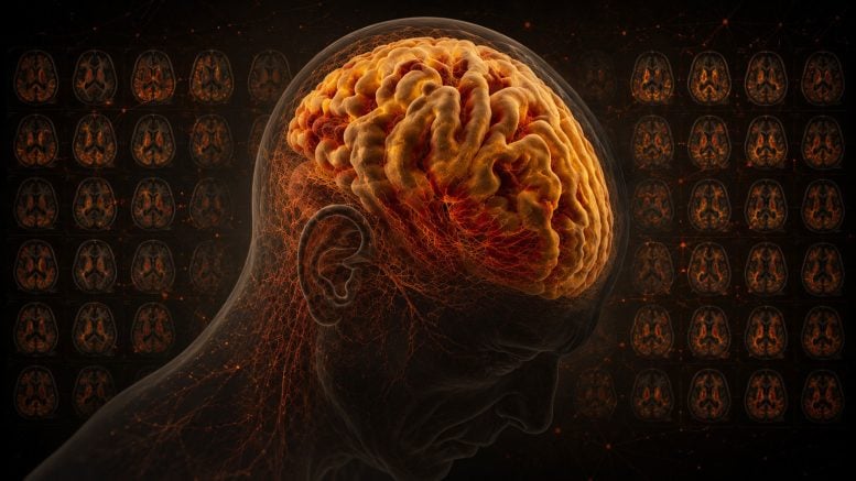 Centiloid Scale Alzheimer’s Disease