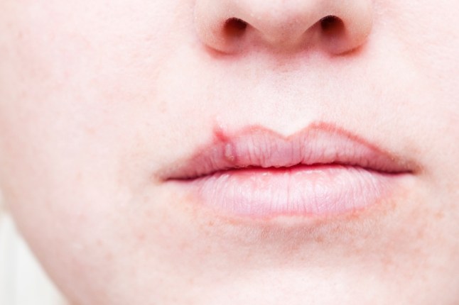 A stock photo of a young girl with a herpes viral cold sore on her lip and mouth.