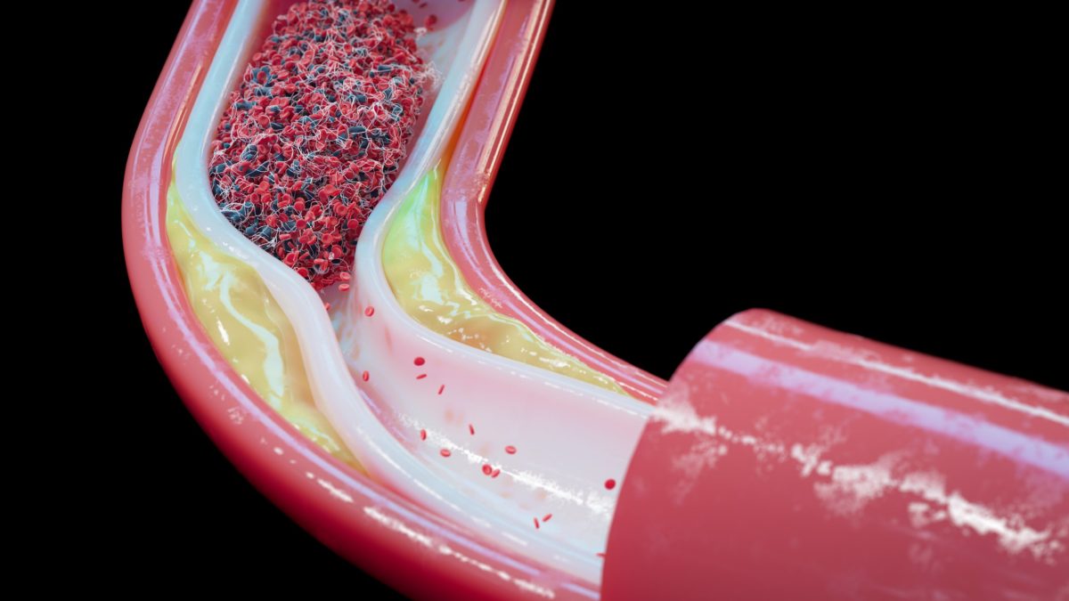 Illustration of a blood vessel with atherosclerosis and a blood clot