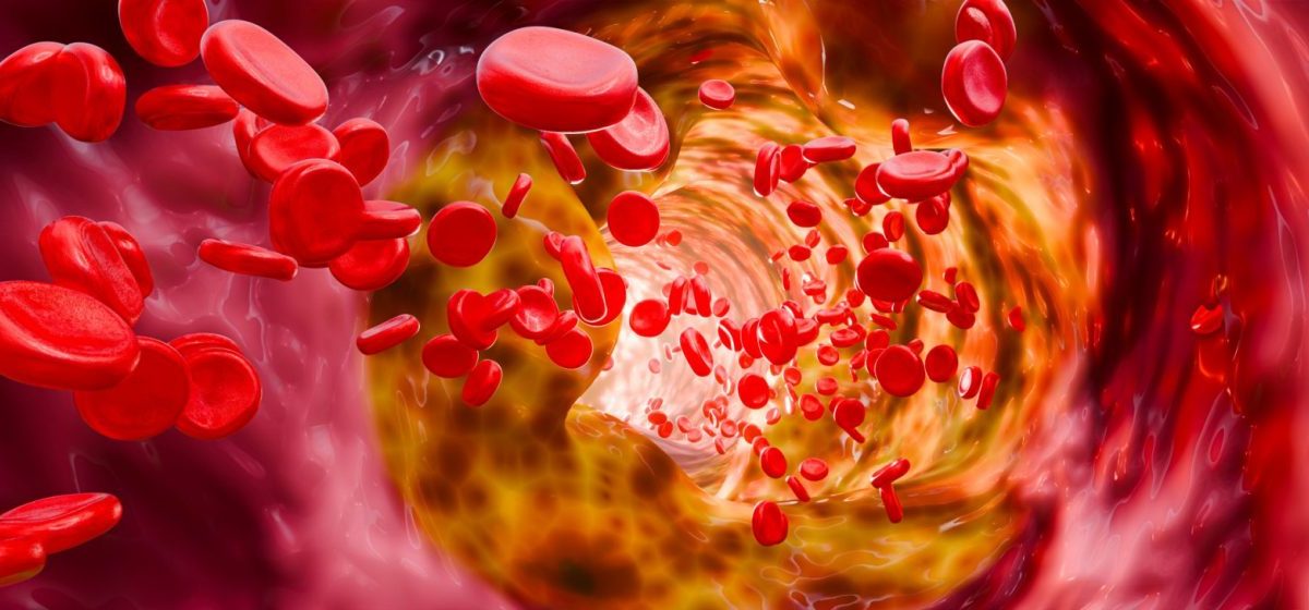 Hyperlipidemia or arteriosclerosis. Blocked artery concept and human blood vessel as a disease with cholesterol fat buildup clogging. Clogged arteries, Cholesterol plaque in the artery. 3D Rendering