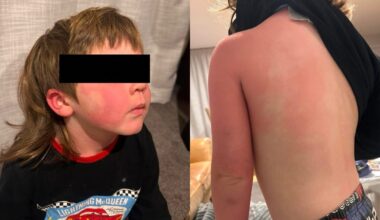 Christchurch mum fears recalled children’s vitamins caused weeks of severe allergic reactions