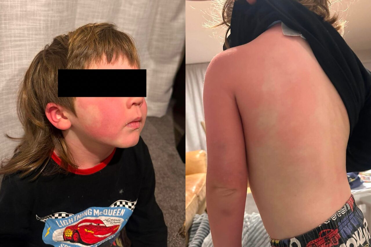 Christchurch mum fears recalled children’s vitamins caused weeks of severe allergic reactions