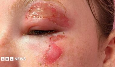 A close-up of a girl's face, where she has suffered burns around her eye and her eyebrow