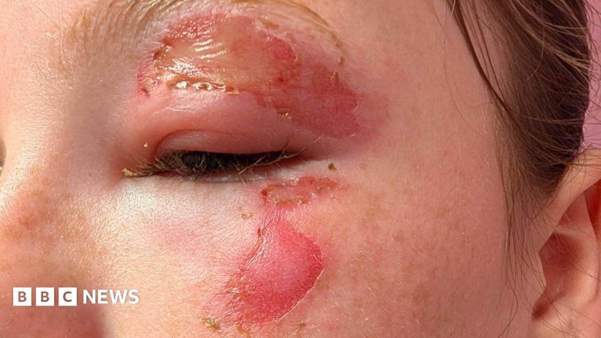 A close-up of a girl's face, where she has suffered burns around her eye and her eyebrow