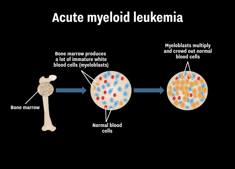 It's not usually clear what causes AML, but the myeloid stem cells produce a lot more white blood cells than needed (UL/Getty Stock Image)