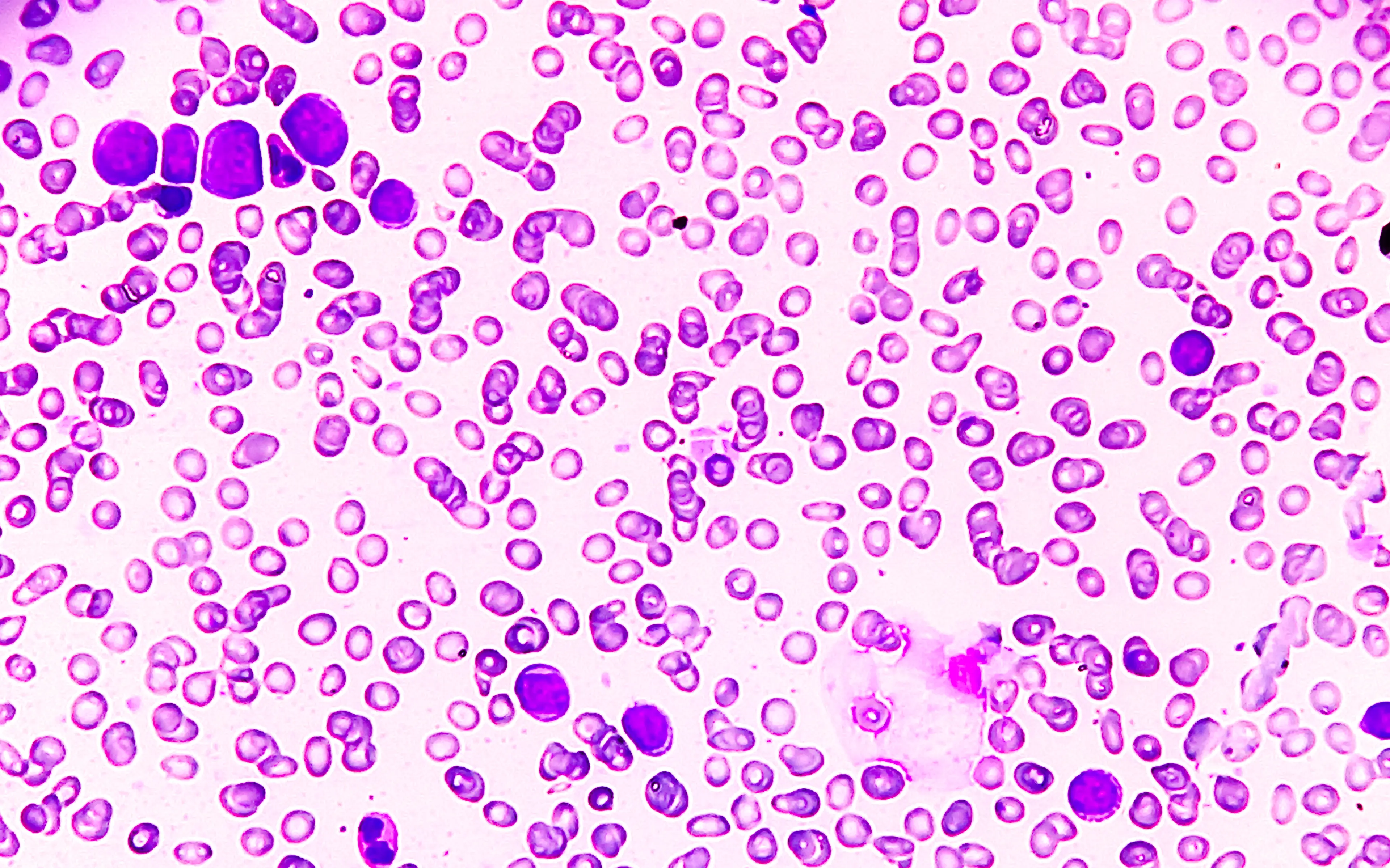 AML is a type of blood cancer (Getty Stock Images)